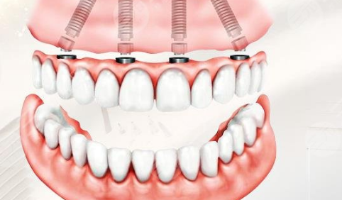 种植牙一千多元是真的吗2