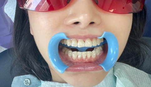 龈下刮治是不是每年要做3