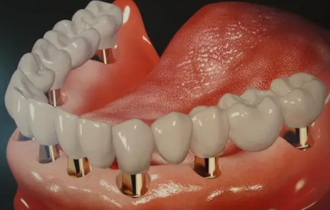 种植牙一千多元是真的吗3